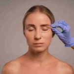 Blefaroplastia-o-que-e-para-que-serve-e-como-funciona-a-recuperacao.webp